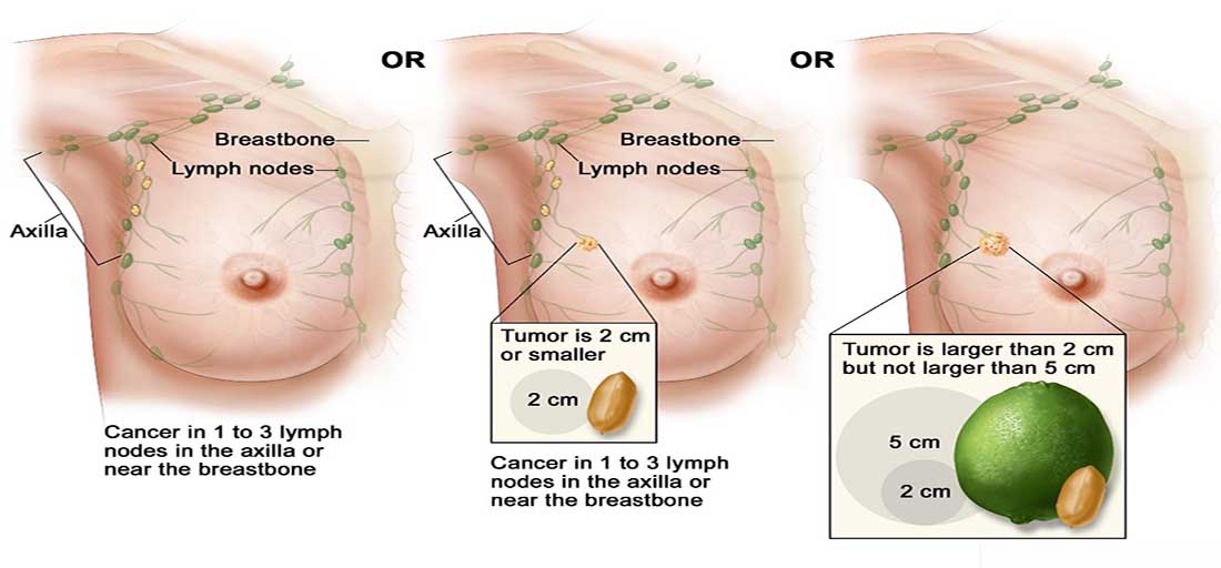 سرطان پستان  